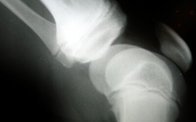 Osteoporosi, con denosumab sicurezza ed efficacia durature per almeno 8 anni