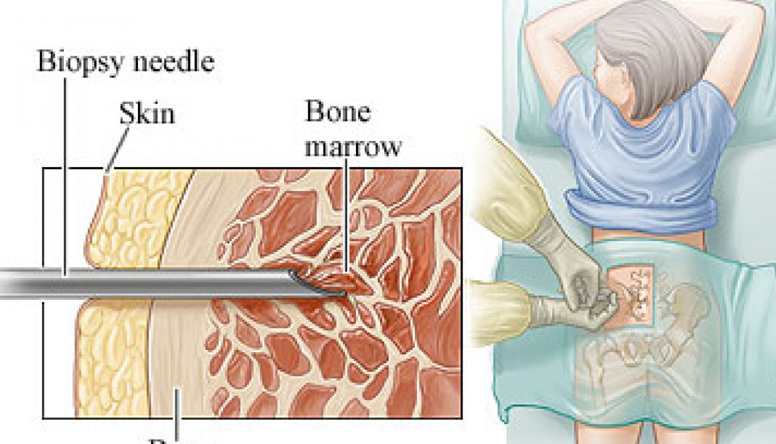 Biopsia ossea: nuove opportunità per i Soci SIOMMMS per la collaborazione SIOMMMS-SIN