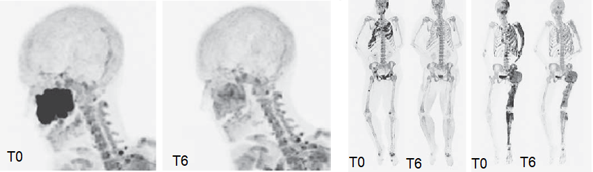 Il denosumab nella displasia fibrosa