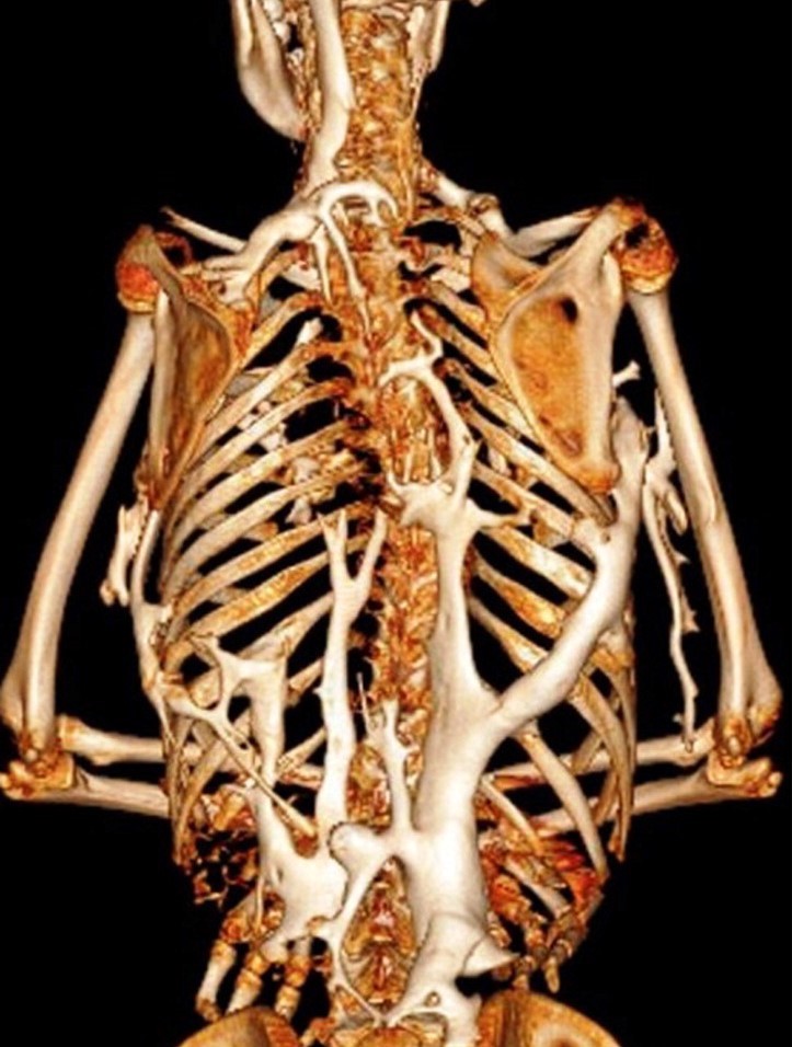 Da una malattia rara l’identificazione di un nuovo gene che contribuisce alla formazione ossea