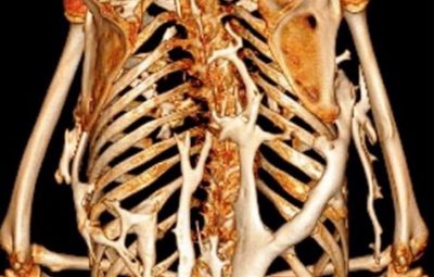 Da una malattia rara l’identificazione di un nuovo gene che contribuisce alla formazione ossea