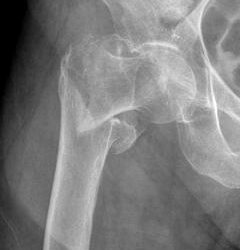 Mortalità e costi di degenza ospedaliera per frattura di femore