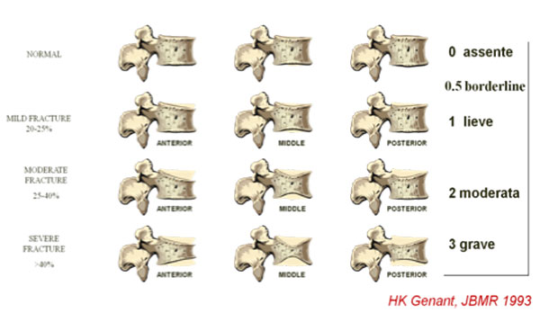 Documento condiviso SIRM – SIOMMMS – OFF Italia “Valutazione strumentale dell’osteoporosi”