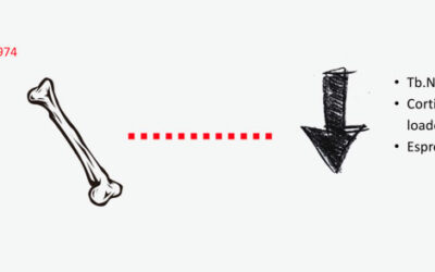 L’inibizione della Porcupine come possibile target per il trattamento della Sclerosteosi